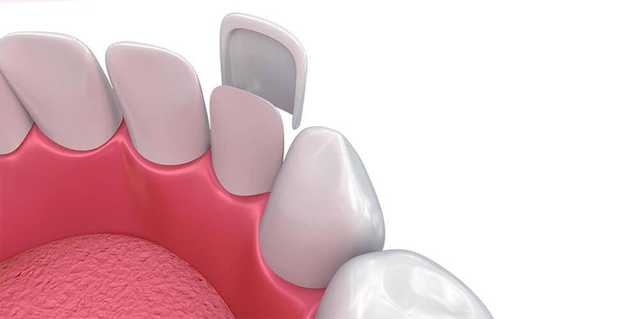 Dental Veneers Medicine Hat