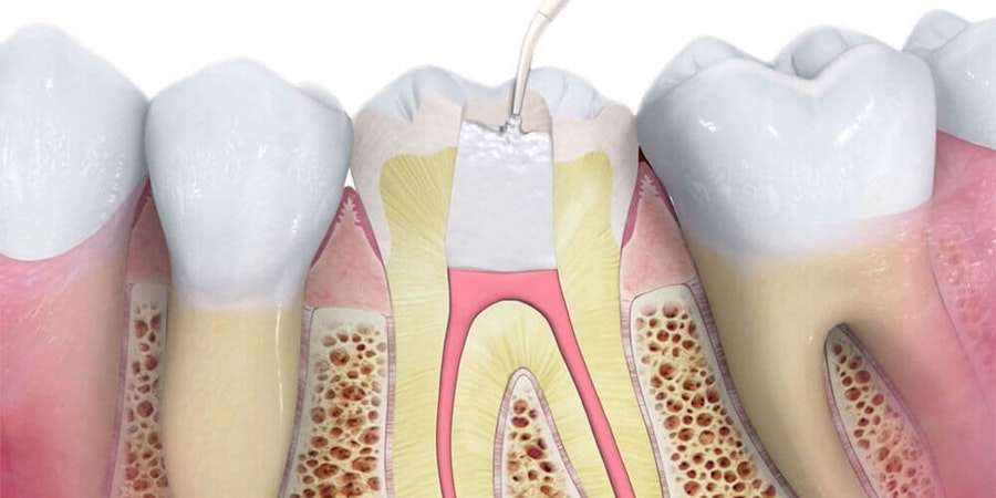Root Canal Treatment Medicine Hat