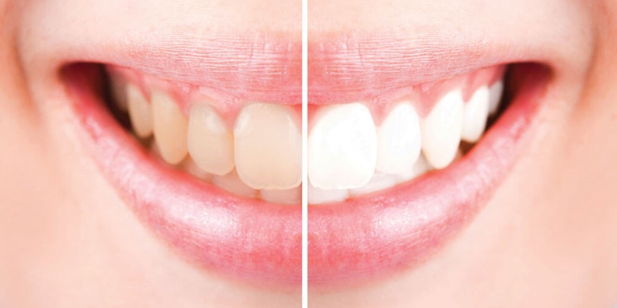 Teeth Whitening Medicine Hat
